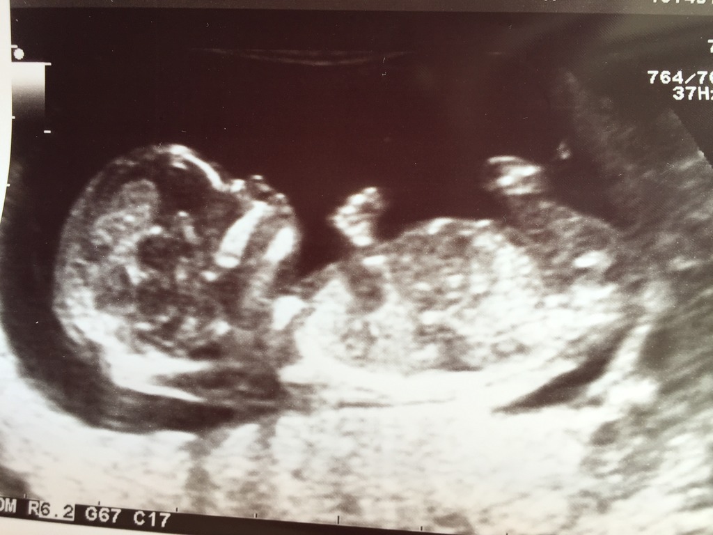 14 weeks ultrasound boy or girl?