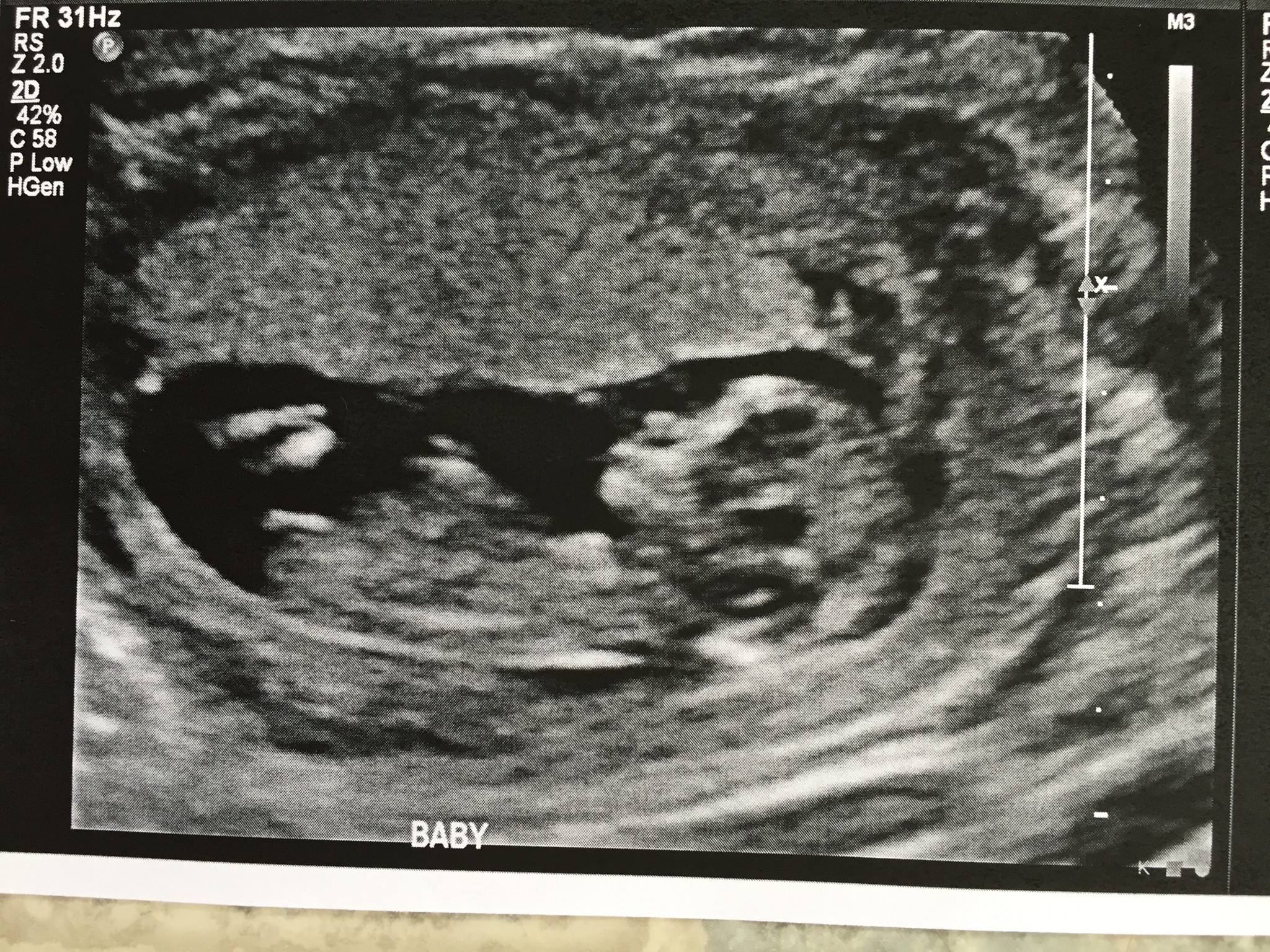 WOAH! Difference between nub at 11 weeks and 12.5 weeks!