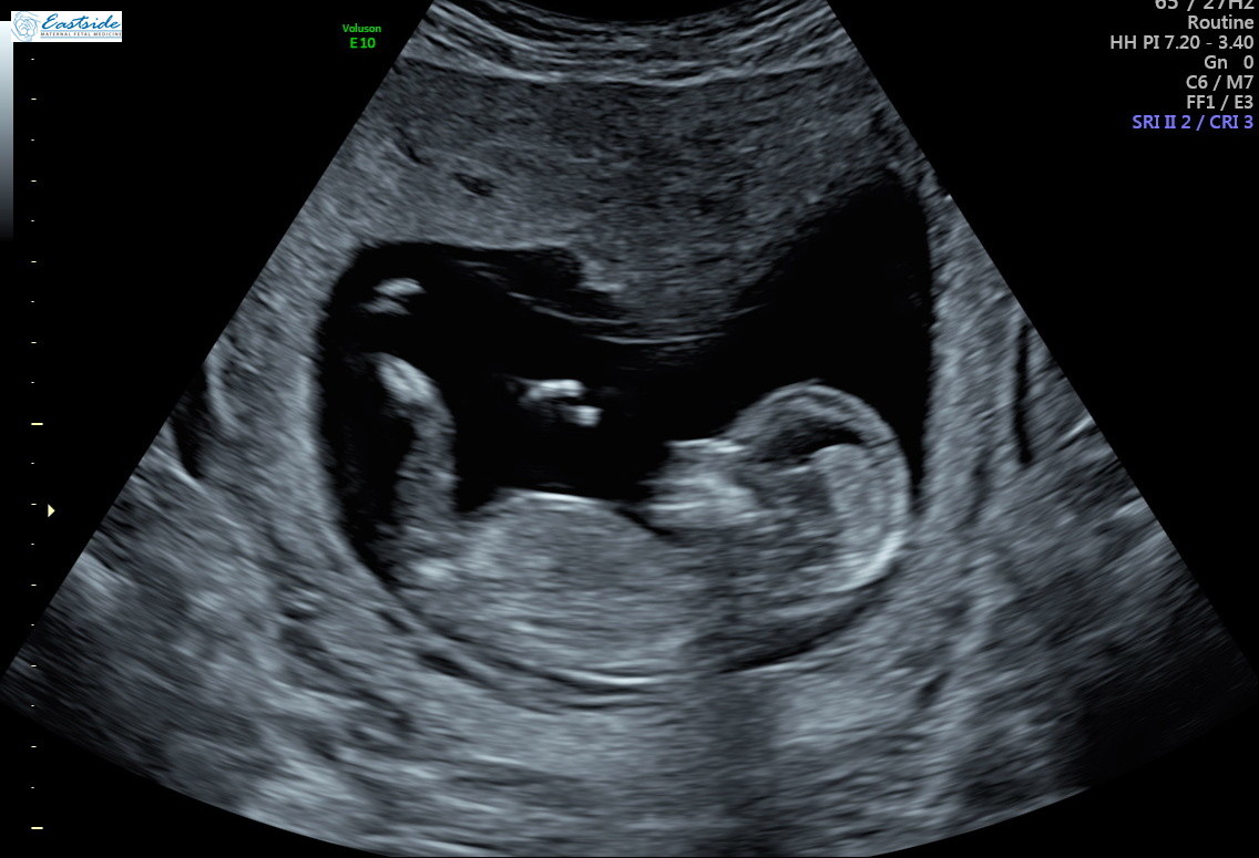 how accurate is a dating ultrasound at 13 weeks