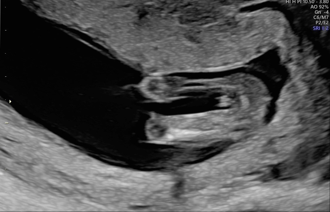 Potty shot early 14 weeks