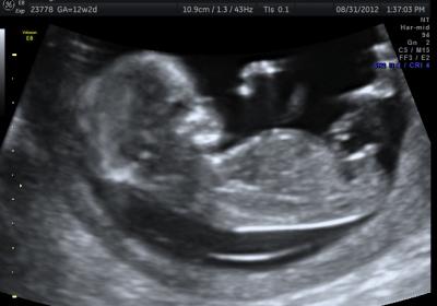 Name:  ultrasound.jpg
Views: 330
Size:  15.2 KB