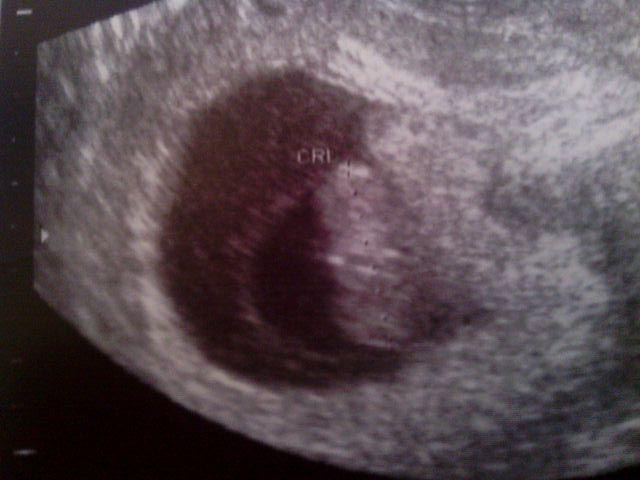 Name:  Haley sonogram March baby.jpg
Views: 135
Size:  37.7 KB