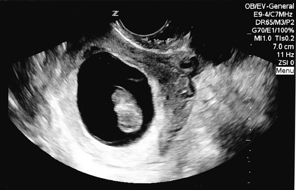 Name:  ultrasound.jpg
Views: 1884
Size:  69.3 KB