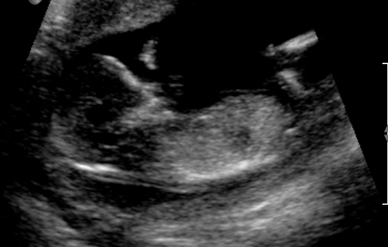 Name:  rsz_pregnancy_ultrasound_0018.jpg
Views: 168
Size:  78.6 KB